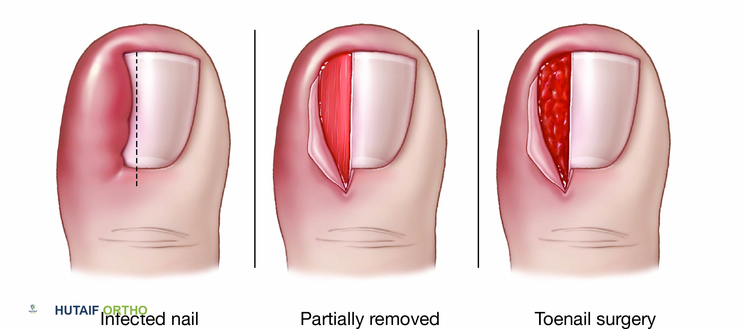 صورة توضيحية لـ الظفر الغارز في اللحم الأسباب، الأعراض، العلاج والوقاية مع الأستاذ الدكتور محمد هطيف