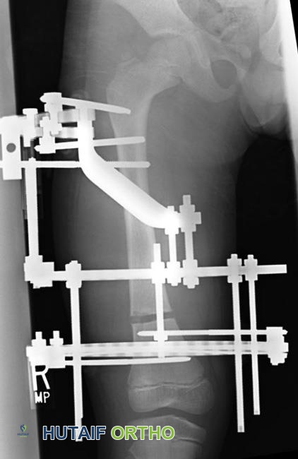 صورة طبية: تفاوت طول الأطراف السفلية الأسباب الأعراض وخيارات العلاج المتقدمة مع الأستاذ الدكتور محمد هطيف