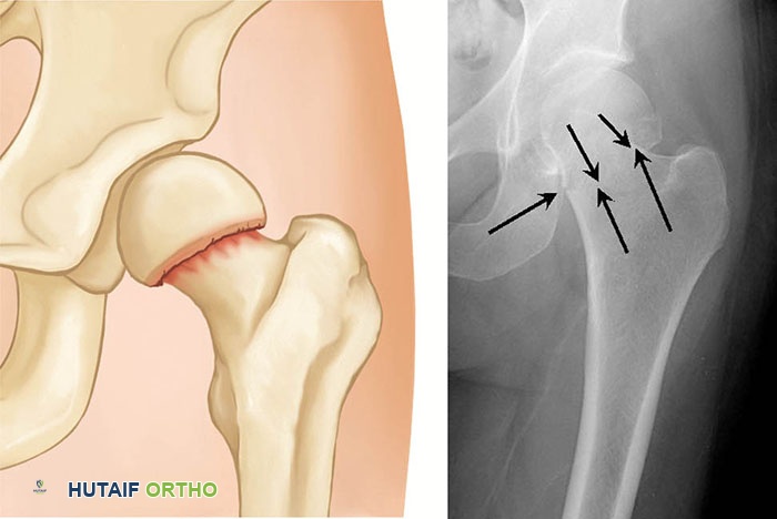 صورة توضيحية لـ كسور الورك: دليل الأستاذ الدكتور محمد هطيف الشامل للتشخيص والعلاج في صنعاء