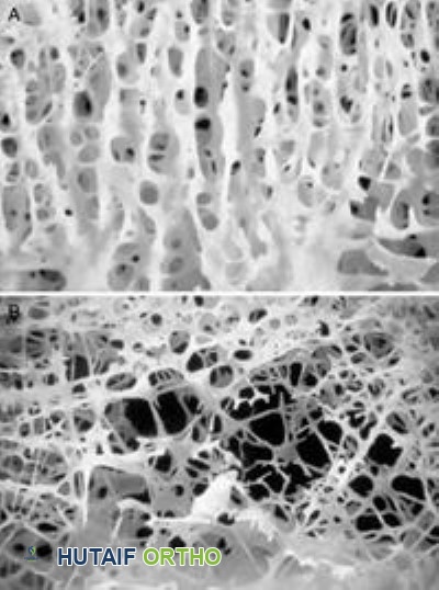 صور مكبرة للعظم الإسفنجي الصحي والمصاب بهشاشة العظام