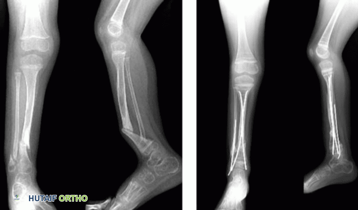 الالتحام الكاذب قبل وبعد الجراحة