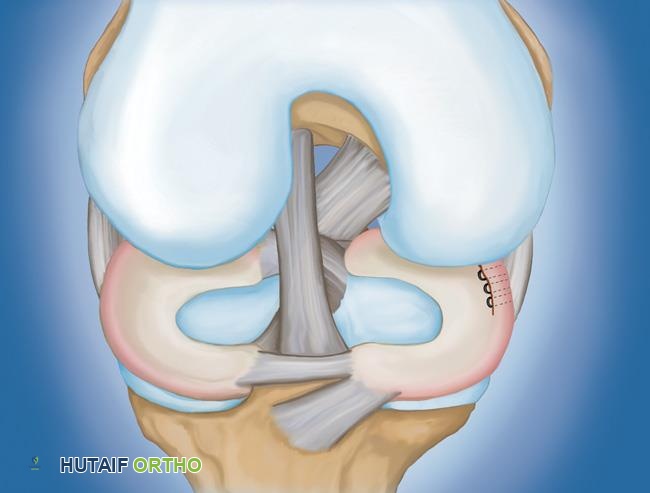 غضروف هلالي ممزق تم إصلاحه بالغرز