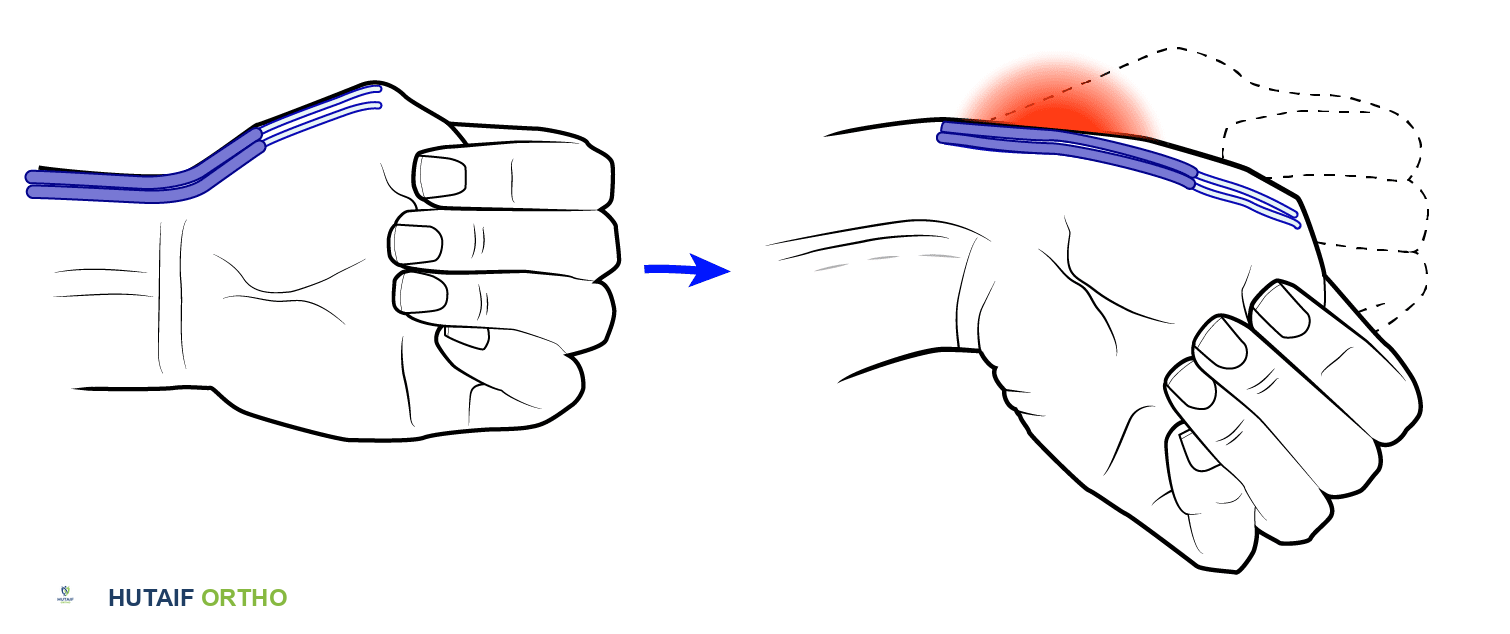 يتضمن اختبار فينكلشتاين/آيكهوف وضع الإبهام في راحة اليد، والإمساك به بالأصابع، وثني الرسغ باتجاه الزند. الألم فوق الحيز الظهري الأول هو علامة إيجابية.