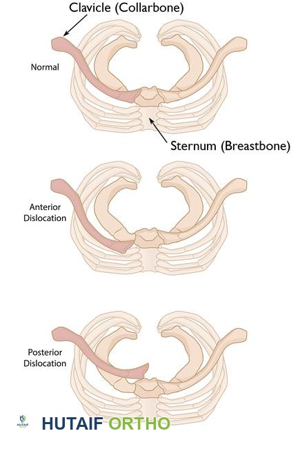 صورة توضيحية لـ اضطرابات المفصل القصي الترقوي: دليلك الشامل للعلاج والتعافي مع الأستاذ الدكتور محمد هطيف