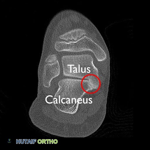 فحص CT للائتلاف الرصغي