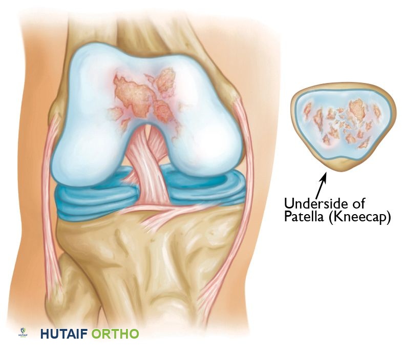 صورة توضيحية لـ التهاب مفصل الرضفة الفخذي: دليل شامل للعلاج والتعافي مع الأستاذ الدكتور محمد هطيف