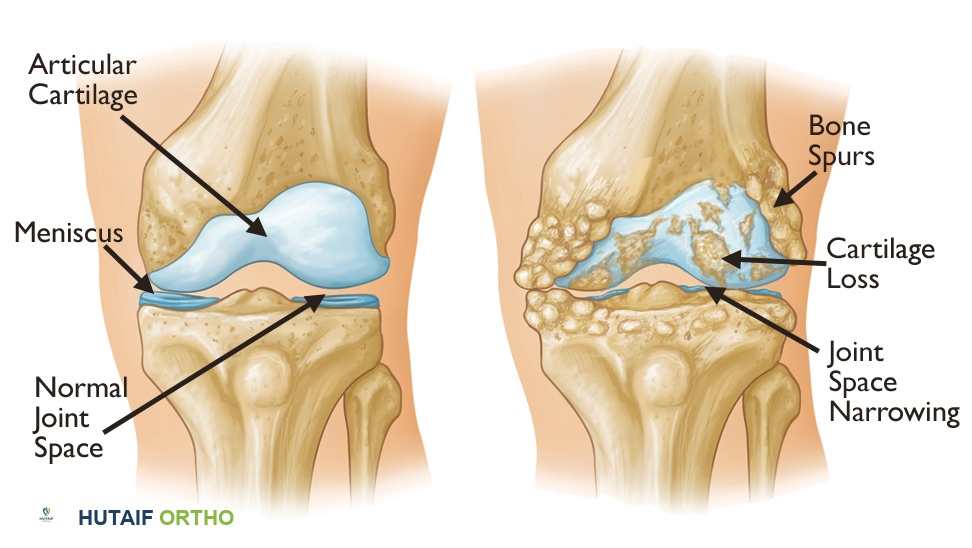 صورة توضيحية لـ خشونة المفاصل: دليل شامل للتشخيص والعلاج والتعافي مع الأستاذ الدكتور محمد هطيف