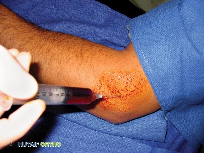 صورة طبية: مرفق التنس (التهاب اللقيمة الوحشية): دليل شامل من الأستاذ الدكتور محمد هطيف