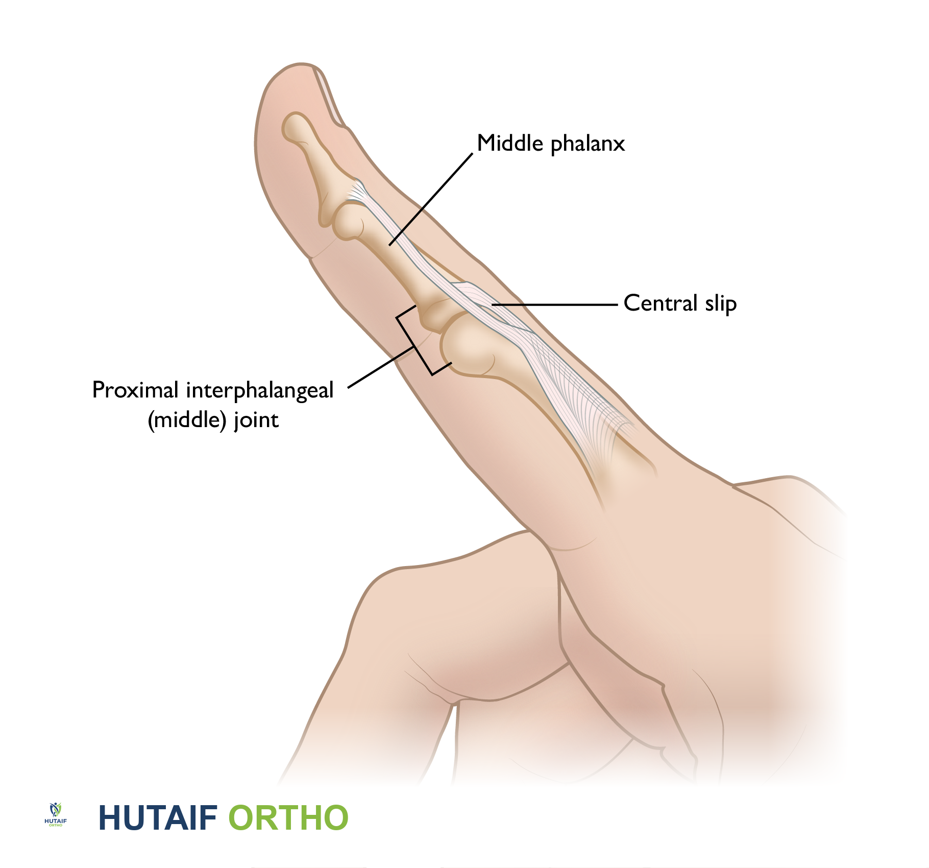 The central slip is the tendon on the top of the finger that helps the finger to straighten the middle (PIP) joint.