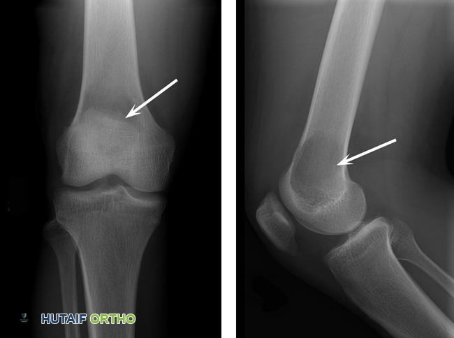 توضيح طبي: ورم الخلايا العملاقة في العظم: دليل شامل للمرضى مع الأستاذ الدكتور محمد هطيف