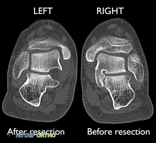 صورة بالأشعة المقطعية لاستئصال الائتلاف الرصغي