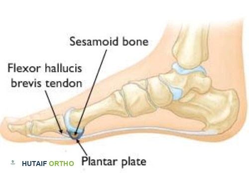 صورة توضيحية لـ إصابة إصبع القدم العشبية (Turf Toe): دليل شامل للمرضى مع الأستاذ الدكتور محمد هطيف
