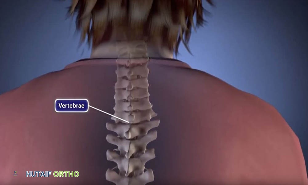 صورة توضيحية لـ الجنف العصبي العضلي عند الأطفال: دليل شامل من الأستاذ الدكتور محمد هطيف