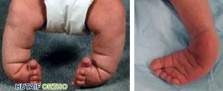 صورة لقدم حنفاء ثنائية