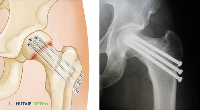 صورة طبية: كسور الورك: دليل الأستاذ الدكتور محمد هطيف الشامل للتشخيص والعلاج في صنعاء