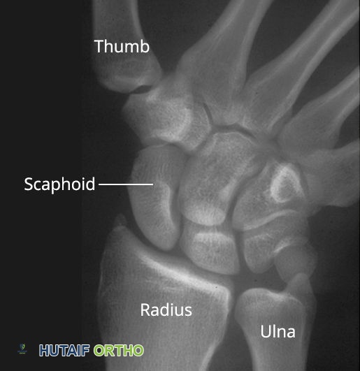 صورة توضيحية لـ التواء الرسغ: دليلك الشامل للتشخيص والعلاج والتعافي مع الأستاذ الدكتور محمد هطيف