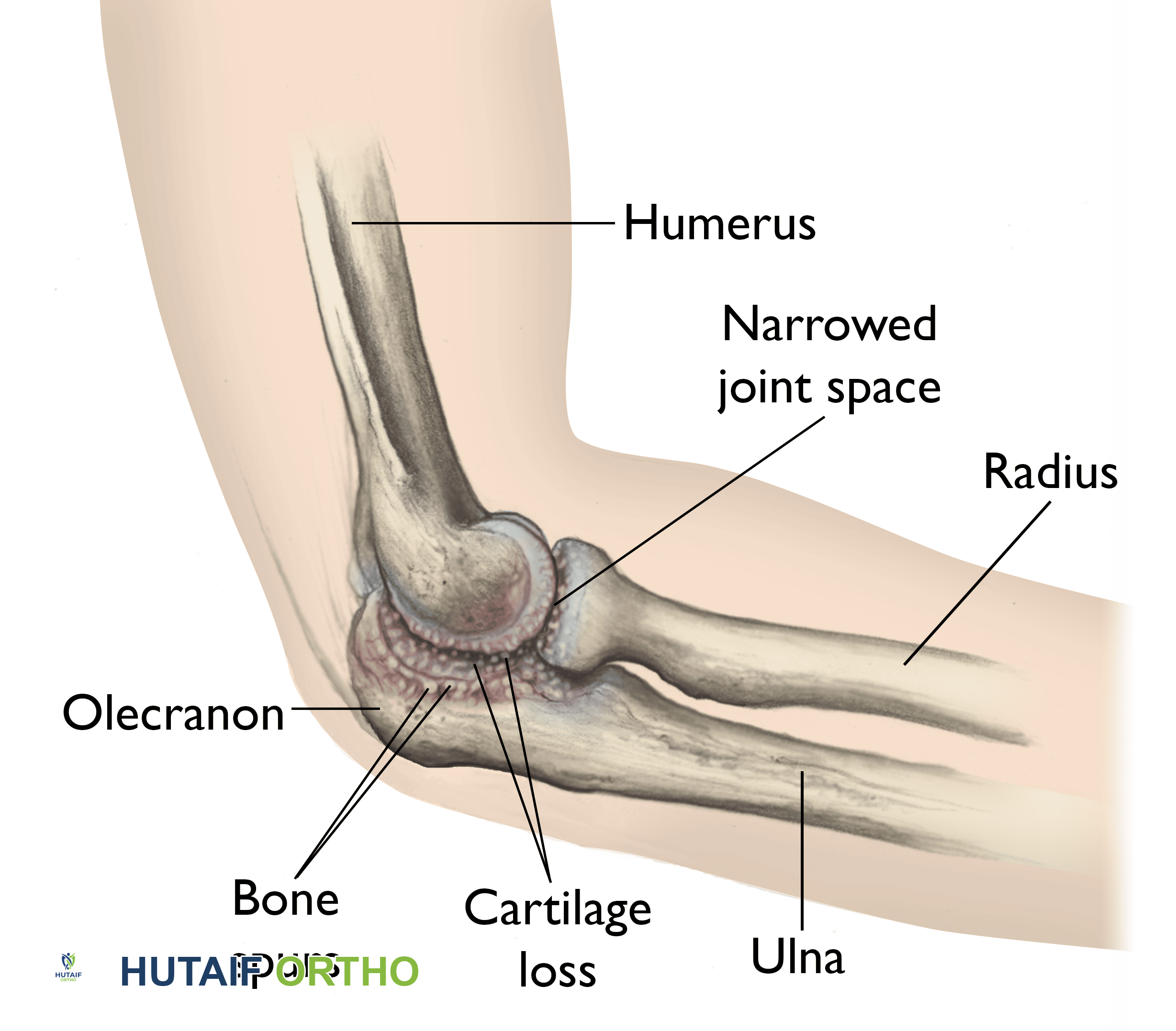 صورة توضيحية لـ خشونة مفصل الكوع: الأسباب، الأعراض، التشخيص، وخيارات العلاج المتقدمة في صنعاء مع الأستاذ الدكتور محمد هطيف