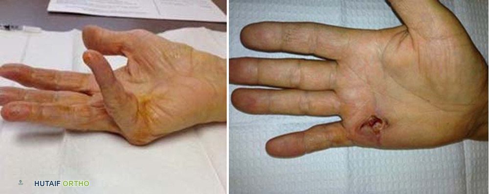 صورة توضيحية لـ مرض دوبويتران: دليل شامل للتشخيص والعلاج مع الأستاذ الدكتور محمد هطيف في صنعاء