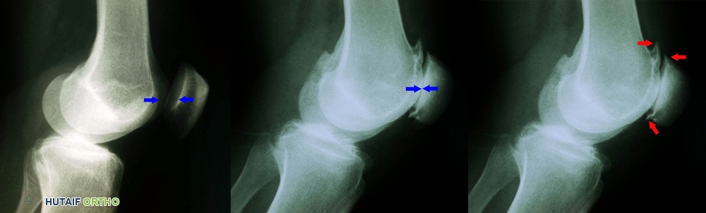 صورة توضيحية لـ التهاب مفصل الرضفة الفخذي: دليل شامل للعلاج والتعافي مع الأستاذ الدكتور محمد هطيف