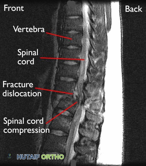 خلع كسر في العمود الفقري الصدري