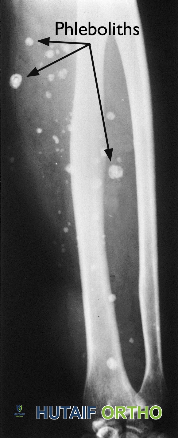 صورة بالأشعة السينية لتكلسات