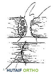 ترميم عصب مع إعادة تنظيم الحزم العصبية