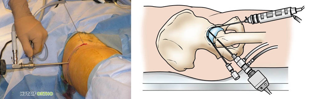 صورة توضيحية لـ الاحتكاك الفخذي الحُقّي (FAI): دليل شامل من الأستاذ الدكتور محمد هطيف