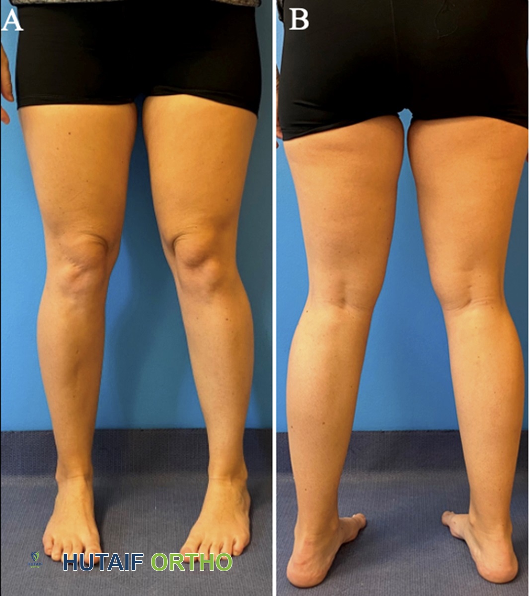 مريض صغير يعاني من التواء الفخذ للأمام في الساقين والتواء الظنبوب في الساق اليمنى