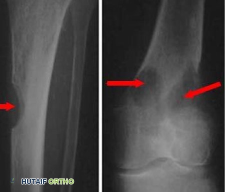 صورة توضيحية لـ الورم النقوي المتعدد والبلازماوي: دليل شامل للمرضى مع الأستاذ الدكتور محمد هطيف