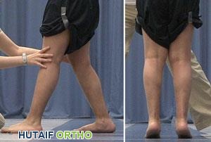 طفل بقدم مسطحة