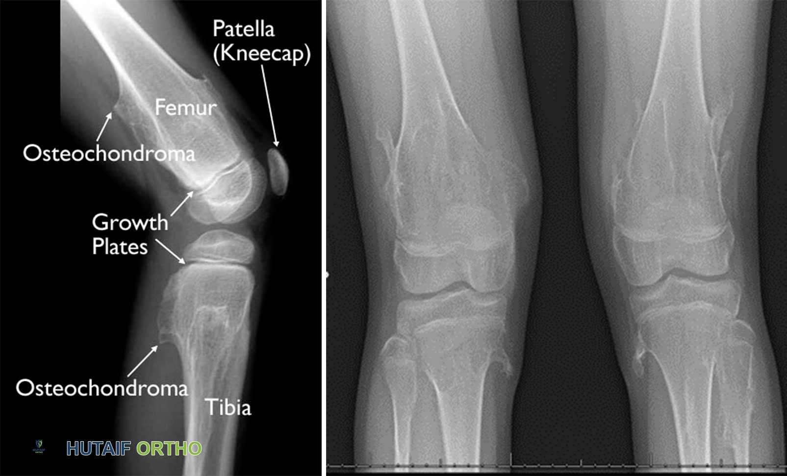 أشعة سينية لركبة طفل تُظهر أورامًا متعددة في عظم الفخذ والساق.