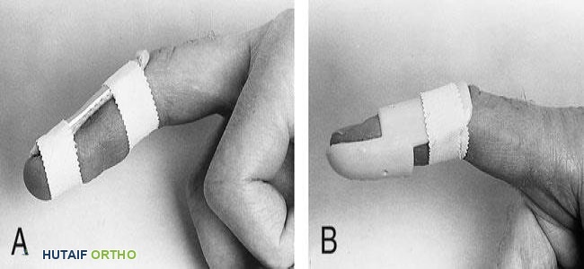 الجبائر لإصبع المطرقة