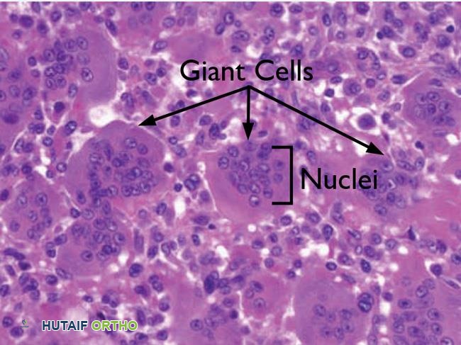 ورم الخلايا العملاقة في العظم: دليل شامل للمرضى مع الأستاذ الدكتور محمد هطيف