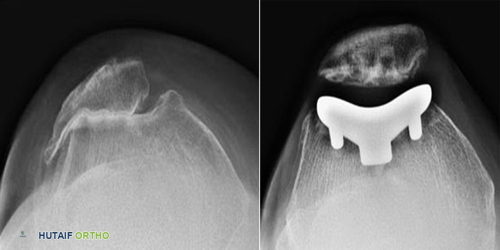 صورة طبية: التهاب مفصل الرضفة الفخذي: دليل شامل للعلاج والتعافي مع الأستاذ الدكتور محمد هطيف