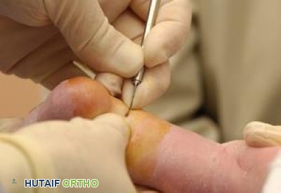 بضع وتر أخيل للقدم الحنفاء