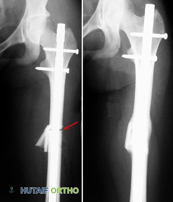 صورة توضيحية لـ تفاوت طول الأطراف السفلية الأسباب الأعراض وخيارات العلاج المتقدمة مع الأستاذ الدكتور محمد هطيف