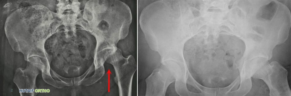 صورة توضيحية لـ خلع الورك: دليل شامل للمرضى من الأستاذ الدكتور محمد هطيف