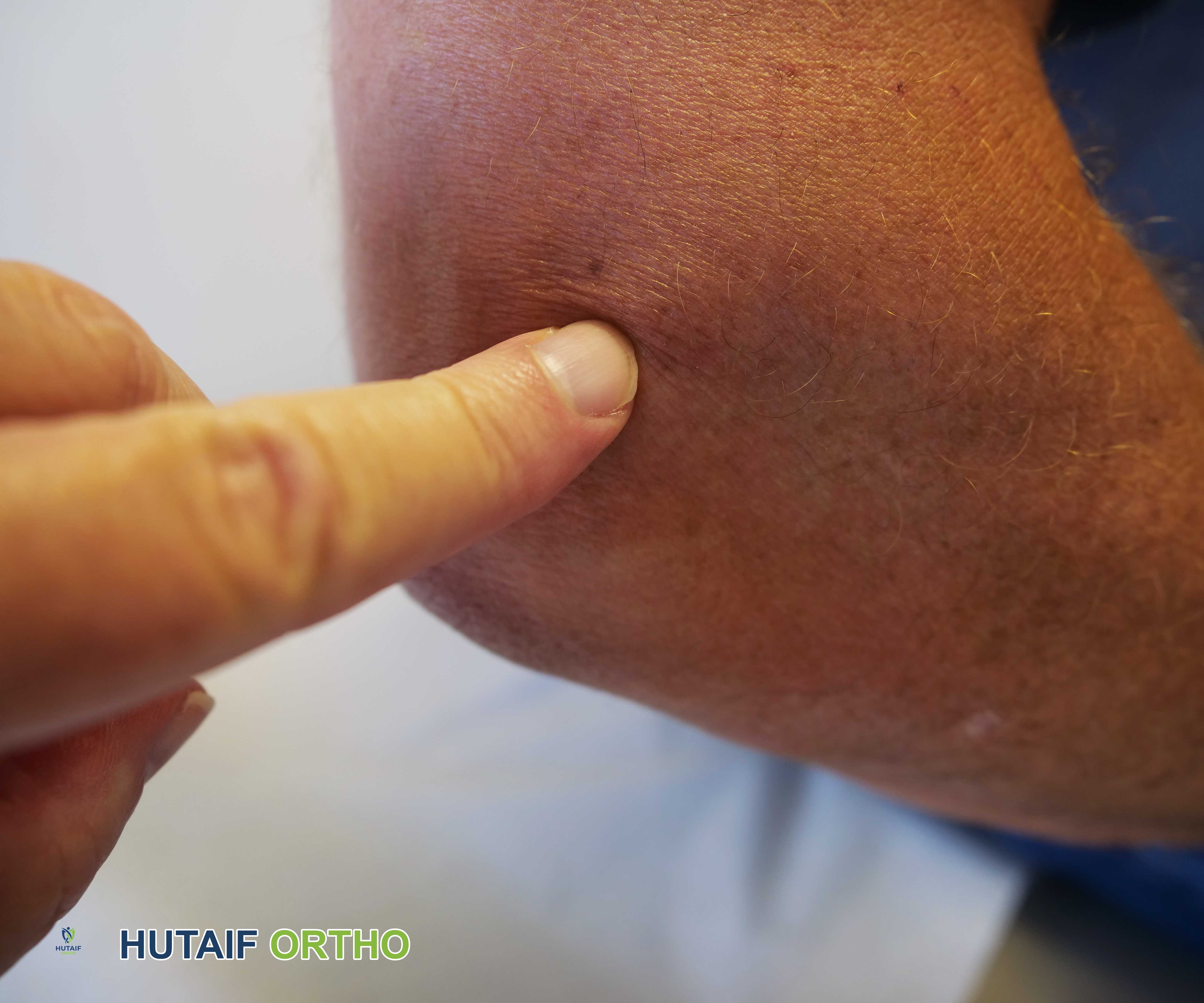 صورة توضيحية لـ مرفق التنس (التهاب اللقيمة الوحشية): دليل شامل من الأستاذ الدكتور محمد هطيف