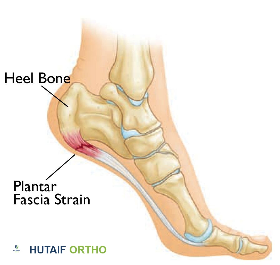 تلف اللفافة الأخمصية