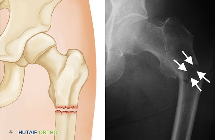 صورة طبية: كسور الورك: دليل الأستاذ الدكتور محمد هطيف الشامل للتشخيص والعلاج في صنعاء