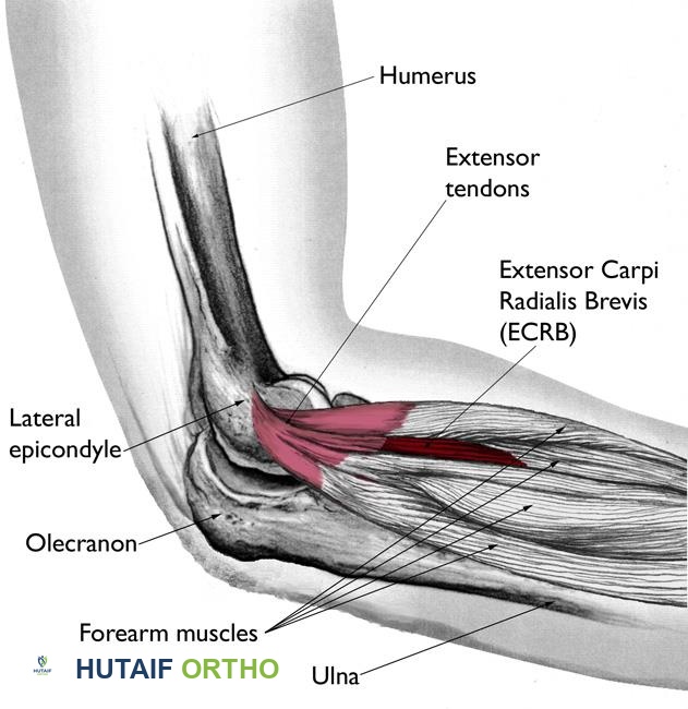صورة توضيحية لـ مرفق التنس (التهاب اللقيمة الوحشية): دليل شامل من الأستاذ الدكتور محمد هطيف
