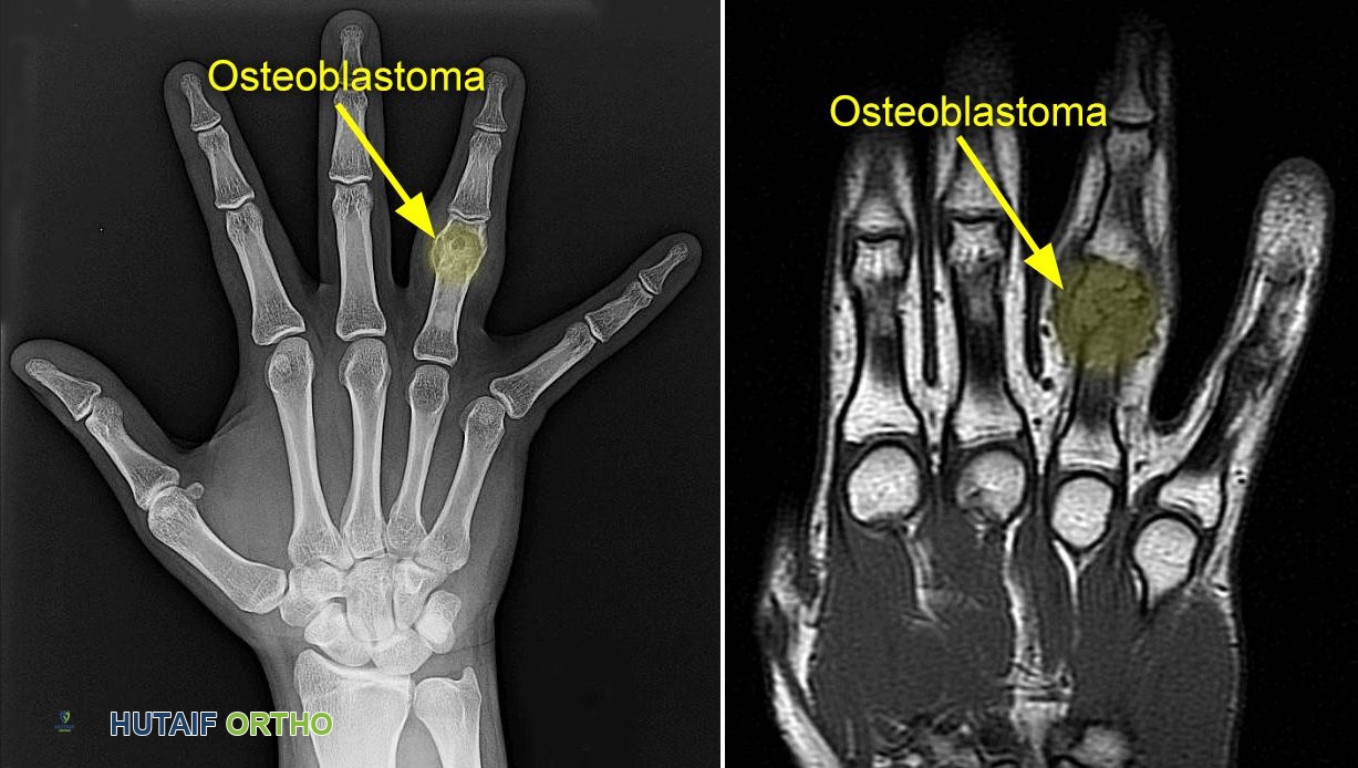 صورة بالأشعة السينية والرنين المغناطيسي لورم عظمي وداني