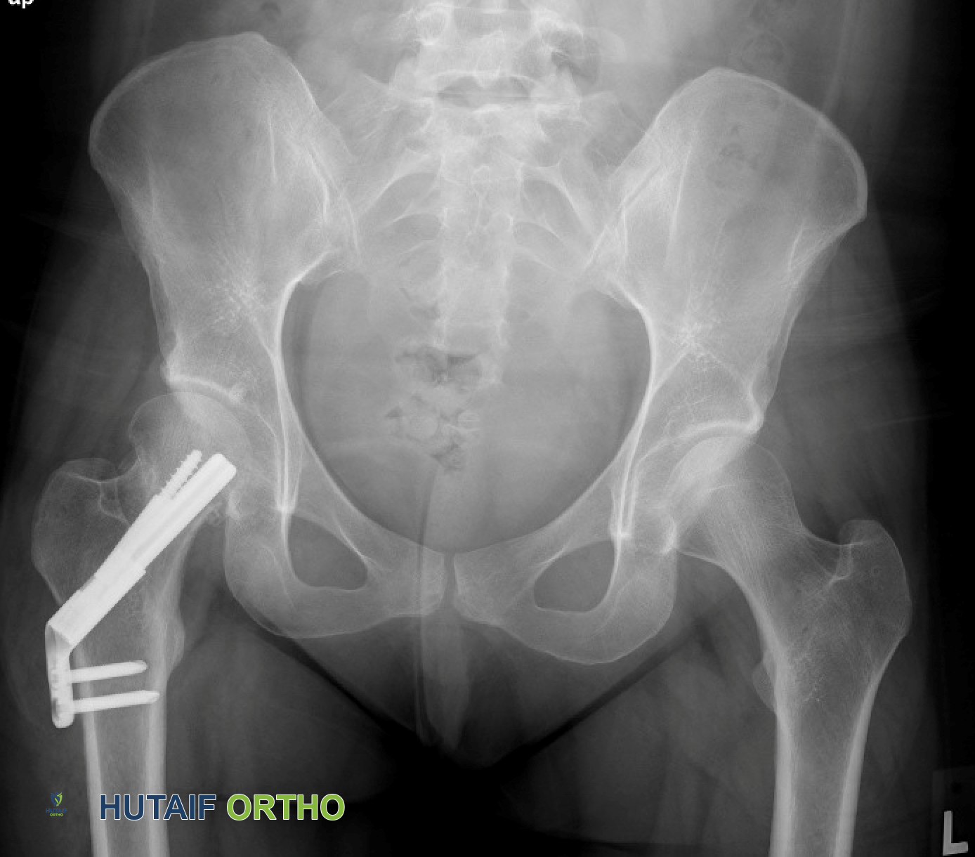 صورة طبية: كسور الورك: دليل الأستاذ الدكتور محمد هطيف الشامل للتشخيص والعلاج في صنعاء