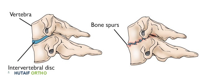 صورة توضيحية لـ الاعتلال الجذري العنقي (انضغاط العصب في الرقبة): دليل شامل من الأستاذ الدكتور محمد هطيف