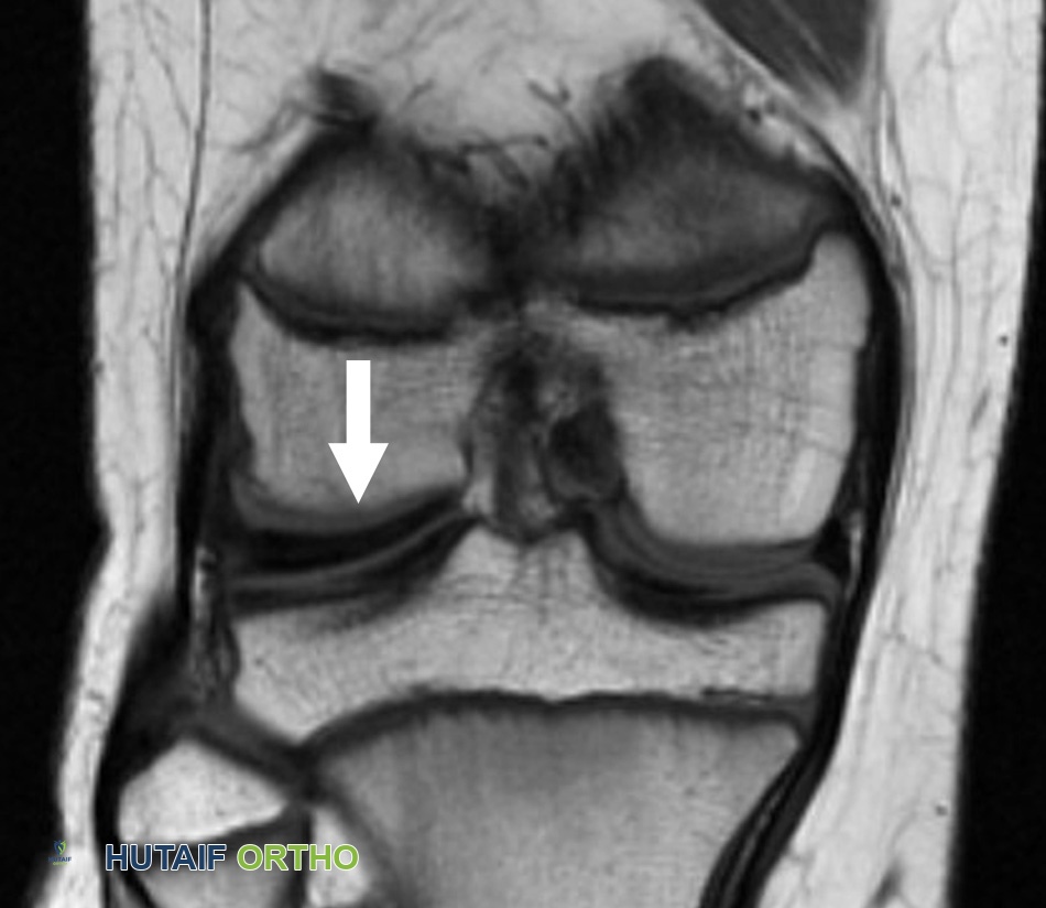 صورة توضيحية لـ الغضروف الهلالي القرصي: دليل شامل للمرضى في اليمن مع الأستاذ الدكتور محمد هطيف