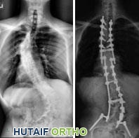الورم الليفي العصبي: دليل شامل للمرضى والعائلات مع الأستاذ الدكتور محمد هطيف