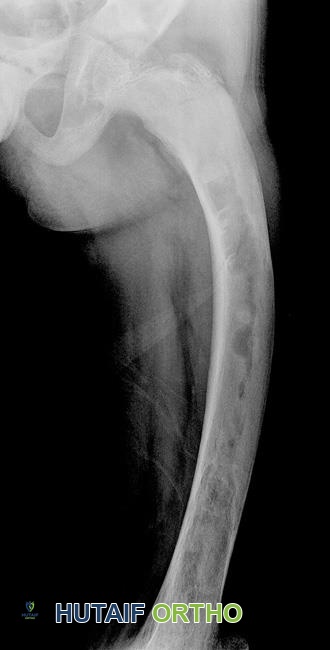 تشوه عظمي ناجم عن خلل التنسج الليفي