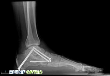 صورة توضيحية لـ القدم المسطحة المكتسبة لدى البالغين تشوه القدم الانبطاحي التدريجي