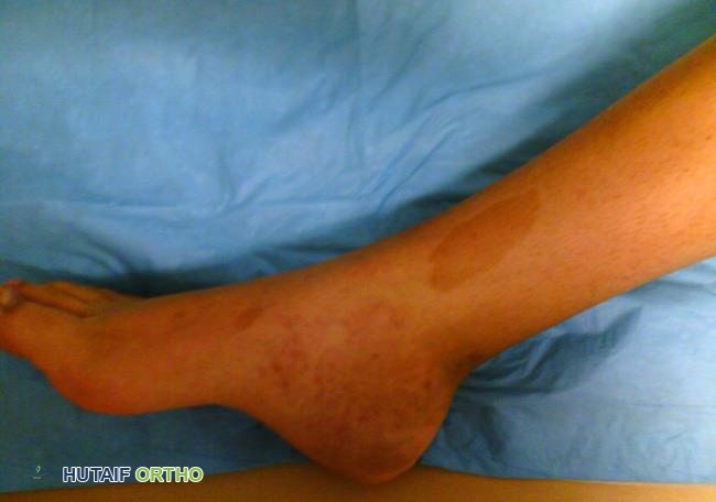 بقع جلدية بلون القهوة بالحليب