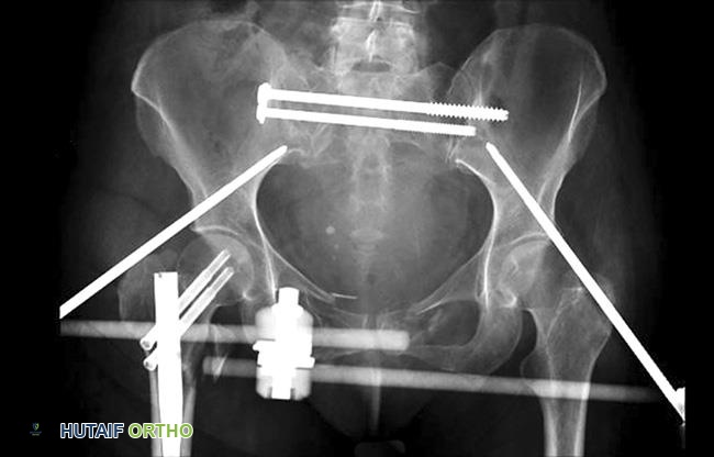 صورة توضيحية لـ كسور الحوض: دليل شامل للمرضى مع الأستاذ الدكتور محمد هطيف في صنعاء